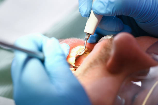 Best Emergency Wisdom Teeth Removal in Citrus Park, FL
